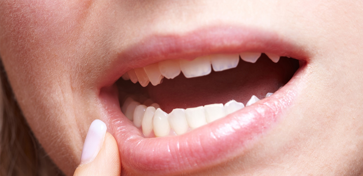 راه حل های مشکلات دندان عقل چیست؟